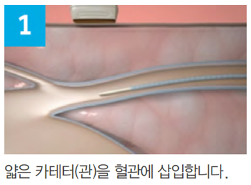 베나실 카테터를 정맥 내 목표 위치까지 진입시키는 첫 단계