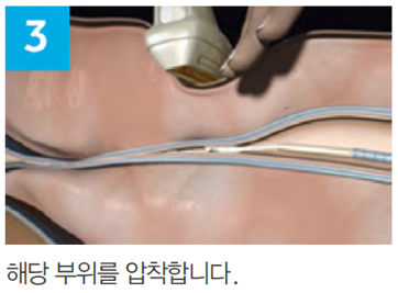 접착제가 주입되며 정맥이 폐쇄되는 베나실 시술 단계