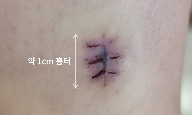 흉터 치료 시술 전
